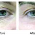 Acupulse / Fractional CO2 laser treatments in Puerto Peñasco, Sonora.